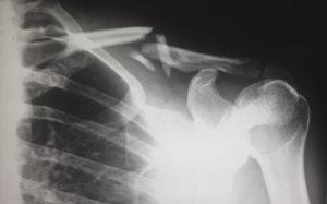 X-ray showing a broken collarbone;  Image by Harlie Raethel via Unsplash.com.